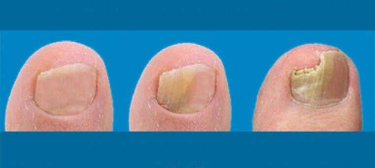 Proceso de desenvolvemento de fungos de uñas