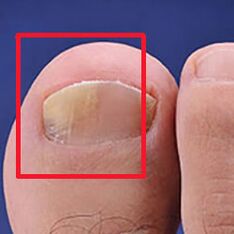 Fungo de micose ou uñas