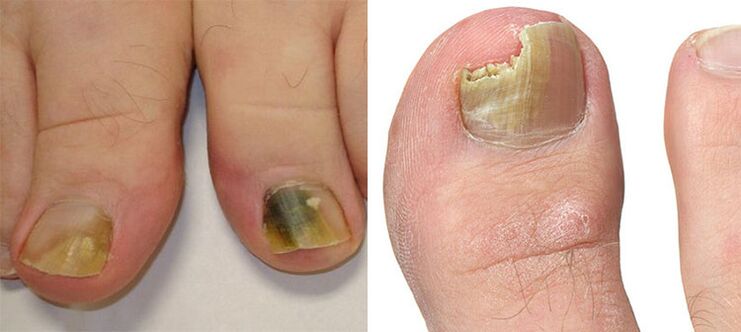 Onicomicosis destrución de uñas cun fungo