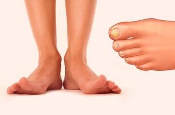 Fungo das uñas