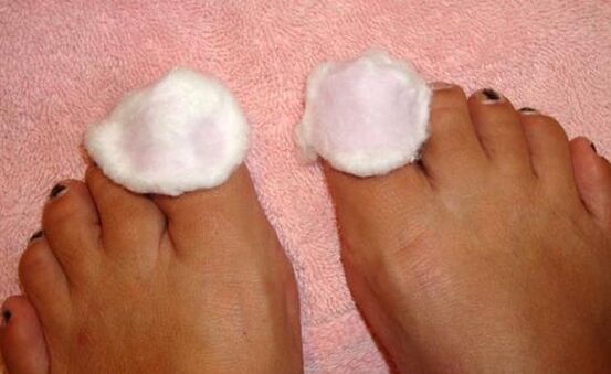 compresa para o tratamento de fungos nas unhas dos pés