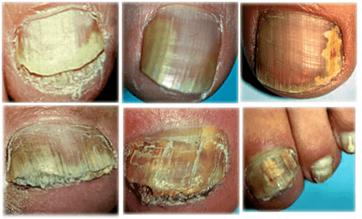 tipos e formas de fungos nas uñas dos pés