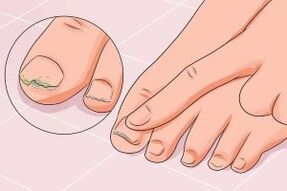 infección por fungos nas unhas